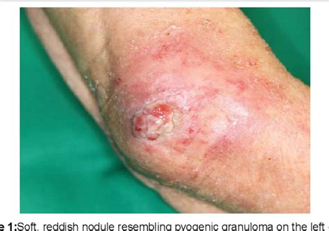 Figure From A Case Of Multiple Cutaneous Metastases From