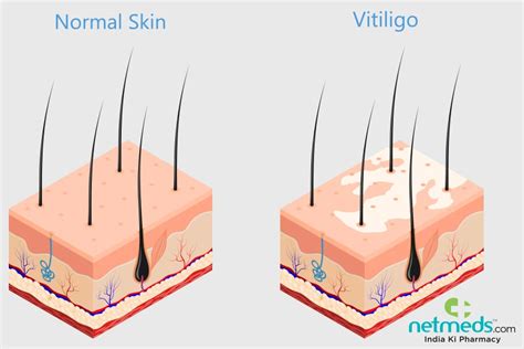 Vitiligo Skin Diagram