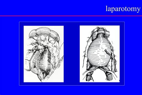 Abdominal Aortic Aneurysm Ppt