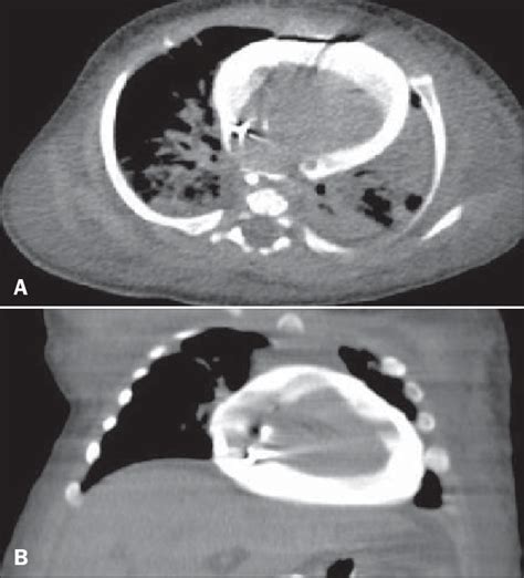 Contrast Enhanced Chest Computed Tomography Images A Axial