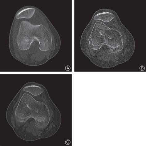 A Preoperative Appearance Of Patellar Dislocation B Postoperative