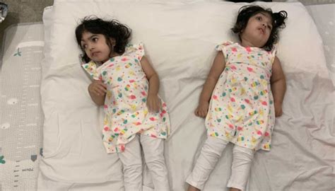 Conjoined Twins Separated Before And After