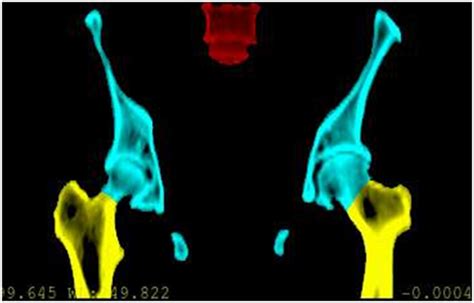 Bony structures of interest for female pelvic radiotherapy. The ...