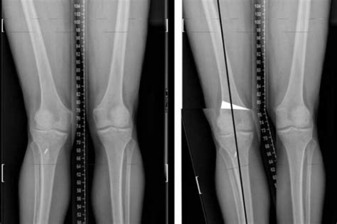 Genu Valgo O Rodillas En X Expertos En Cirugia De Rodilla Sportme