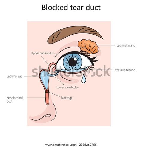 Blocked Tear Duct Structure Diagram Hand Stock Vector (Royalty Free) 2388262755 | Shutterstock