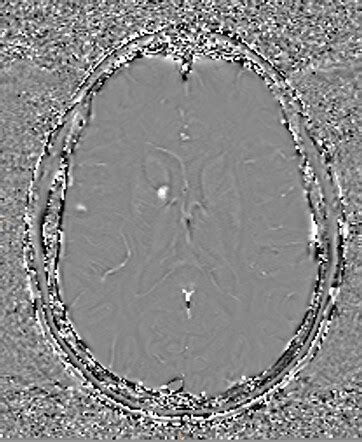 Radiation Induced Meningiomas And Cavernous Malformations Image