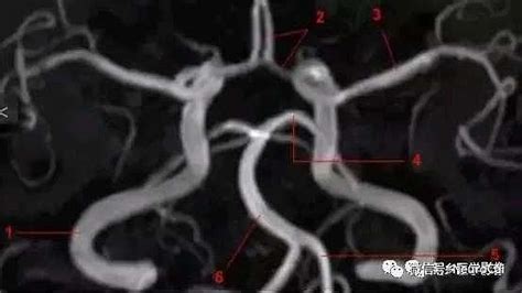 Willis Willis Willis Circle Of Willis Cerebral