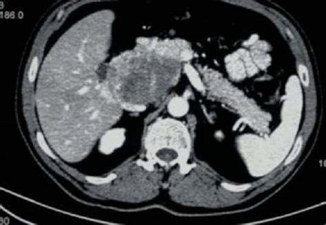 Retroperitoneal Mass