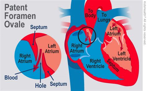 Patent Foramen Ovale Pfo For Parents Nemours Kidshealth