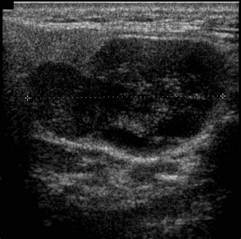 A Study To Evaluate The Accuracy Of Ultrasound In The Diagnosis Of