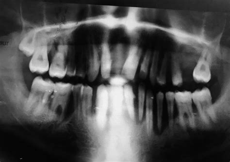 Peripheral giant cell granuloma: A case report - Asian Journal of Oral ...