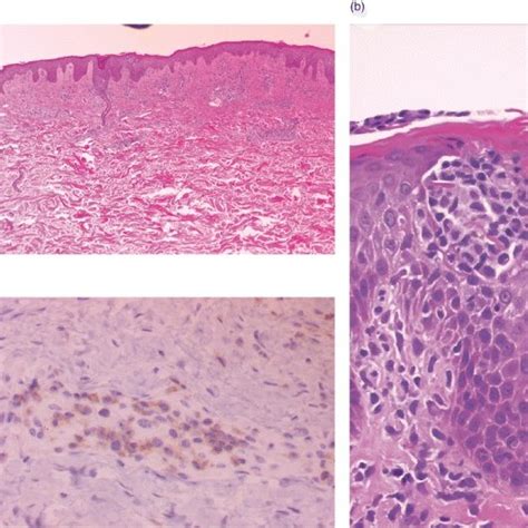 Histopathologic Findings In A Skin Biopsy Specimen A Atypical