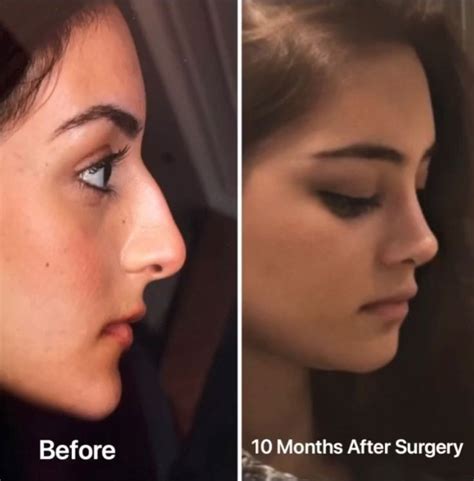 Pin Di Medipars Su Rhinoplasty Before After Chirurgia Plastica