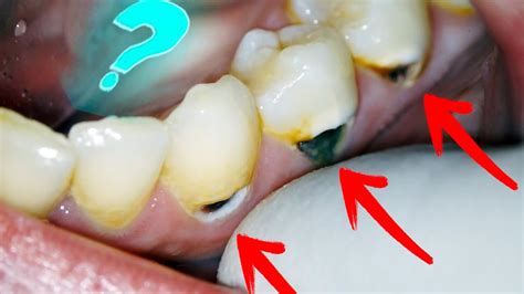 Black Spots On Gums