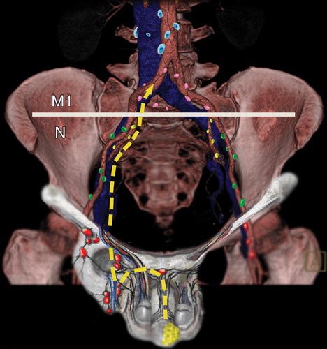 Intrapelvic Lymph Nodes