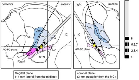 Frontiers A Case Report Dual Lead Deep Brain Stimulation Of The