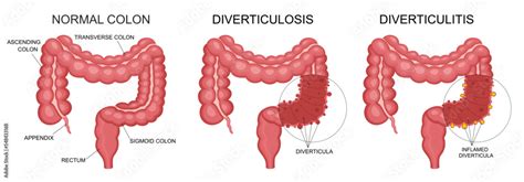 Diverticulitis And Diverticulosis Vector Illustration Medical