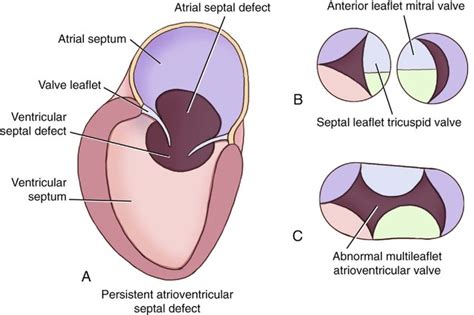 Atrial Septal Defects Radiology Key