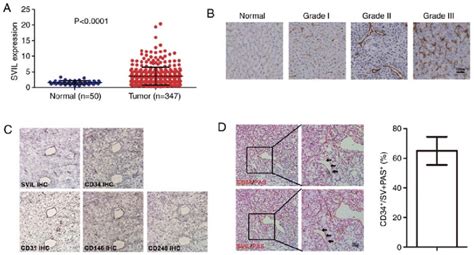 Svil Is Highly Expressed In Liver Cancer And Localized To New Tumor