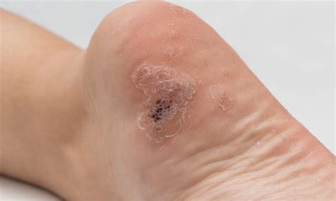 How To Get Rid Of Plantar Warts For Good Premier Podiatry