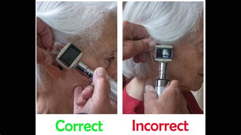 Otoscopy Assessment at Frederick Spinks blog