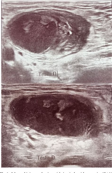 Figure 1 From Acute Abdomen Revealing A Testicular Torsion Of An