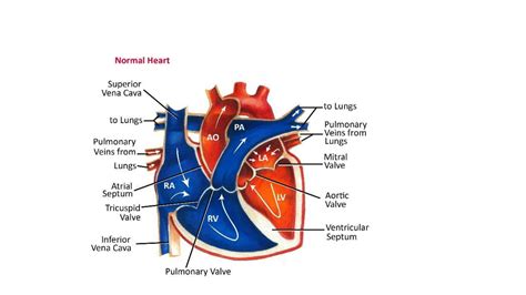 SOLUTION Tetralogy Of Fallot Studypool