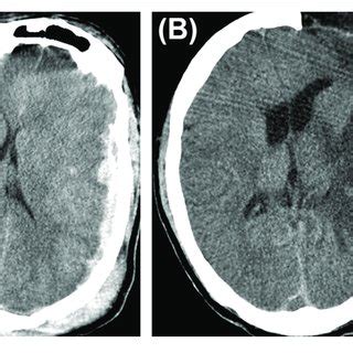 | Cerebral herniation. (A) A case of traumatic brain injury depicting ...