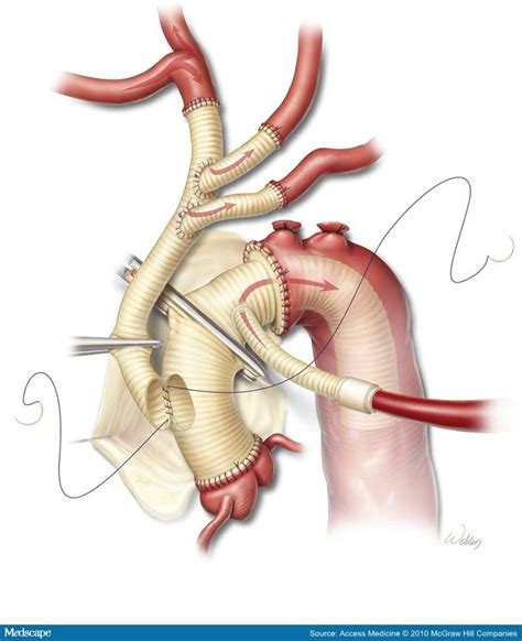 Aortic Dissections And Thoracic Aneurysms An Update In 2022 Aortic