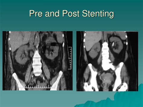 Ppt Is Conservative Management Effective In Emphysematous Pyelonephritis Powerpoint