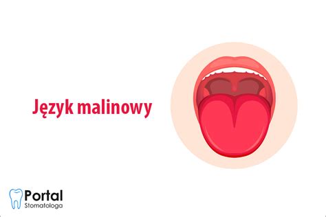 Malinowy język Portal Stomatologa