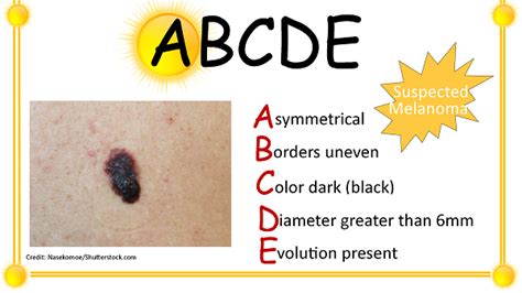 Melanoma Abcde Rule