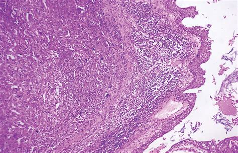 Mature Cystic Teratoma Of Ovary With Squamous Cell Carcinoma Arising