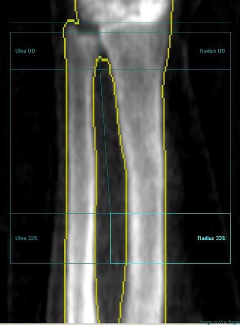 Bone Densitometry Robin K Dore Md Inc