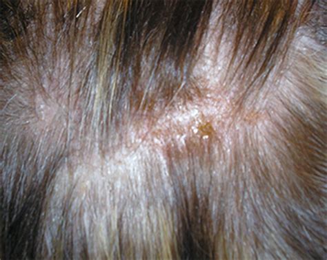 Irritant Dermatitis Contact Dermatitis Solent Trichology Clinic