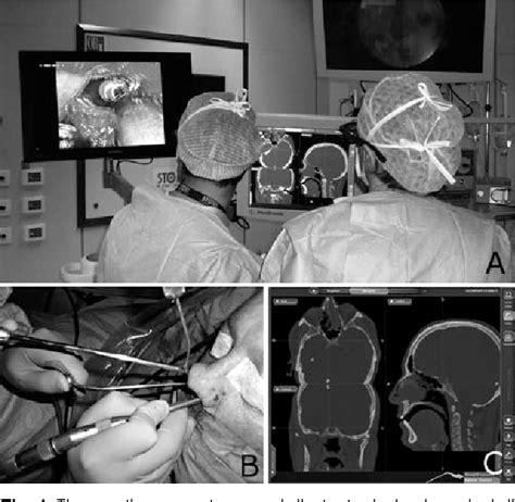 Figure 1 From Endoscopic Transnasal Resection Of Anterior Skull Base