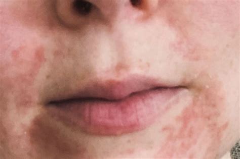 What Is Perioral Dermatitis All About Its Causes Treatments And