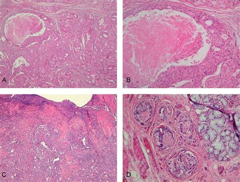 Carcinoma Ex Pleomorphic Adenoma Of Soft Palate With Cavernous Sinus