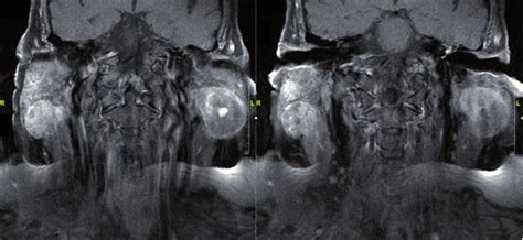 Pre Operative MRI Coronal Section Three Parotid Masses Are Shown Two