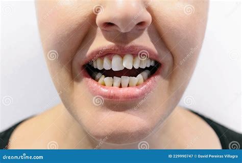 Woman Open Mouth With Crooked Teeth Stock Image Image Of Ugly Bite