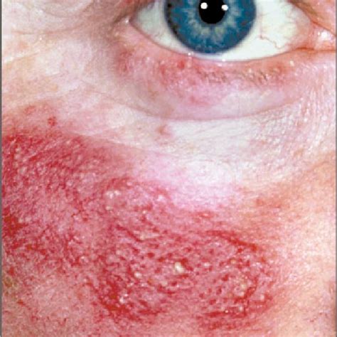 Papulopustular Subtype 2 And Ocular Subtype 4 Rosacea Of Moderate Download Scientific