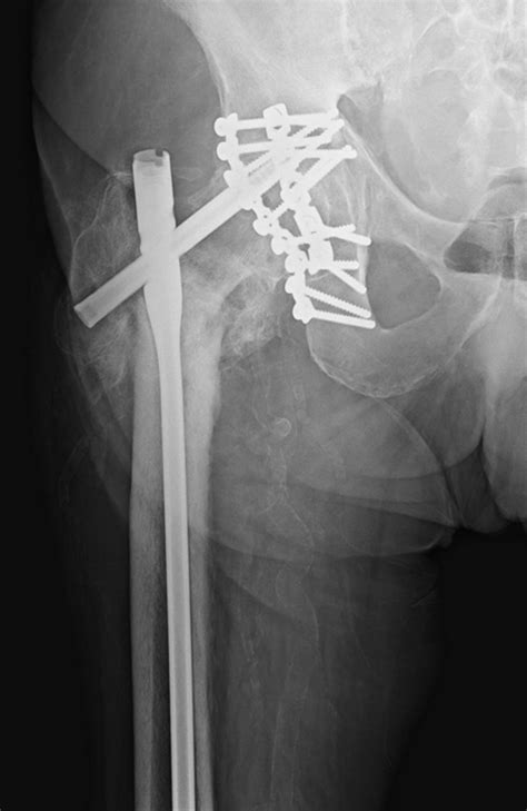 Acetabular Fractures Bone And Joint