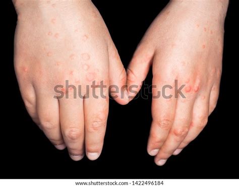 Child Red Rash Coxsackievirus On Both Stock Photo 1422496184 | Shutterstock