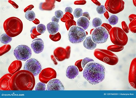 Leucemia Lymphoblastic Aguda Ilustra O Stock Ilustra O De Anormal