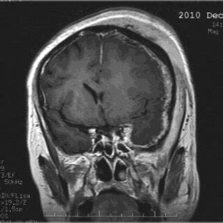 Coronal Contrast Enhanced T Weighted Magnetic Resonance Imaging Scan