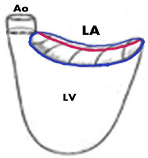 Scheme of the mitral valve anatomy with the saddle shaped annulus (... | Download Scientific Diagram