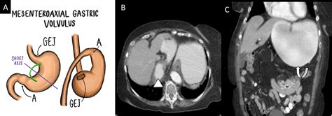 Twists And Turns In Acute Abdomen Imaging Spectrum Of Torsions And