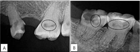 Periapical Radiograph Of The A Upper Left Molars And B Lower Right