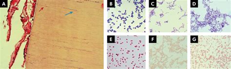 Bacterial Penetration Into Dentinal Tubules And Examples Of Gram