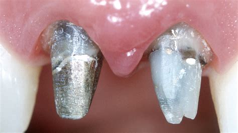 Microcirugía periodontal para la reconstrucción de papilas asociada a